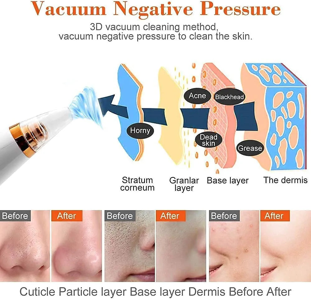 Electric Blackhead Remover | Pore Vacuum Suction Device for Face & Nose | Rechargeable Acne & Whitehead Extractor with 5 Probes